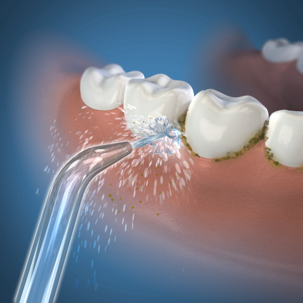 Waterpik Classic Jet pótfej (2 db)