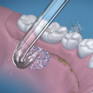 Waterpik Implant Denture Tip pótfejek, 2 db